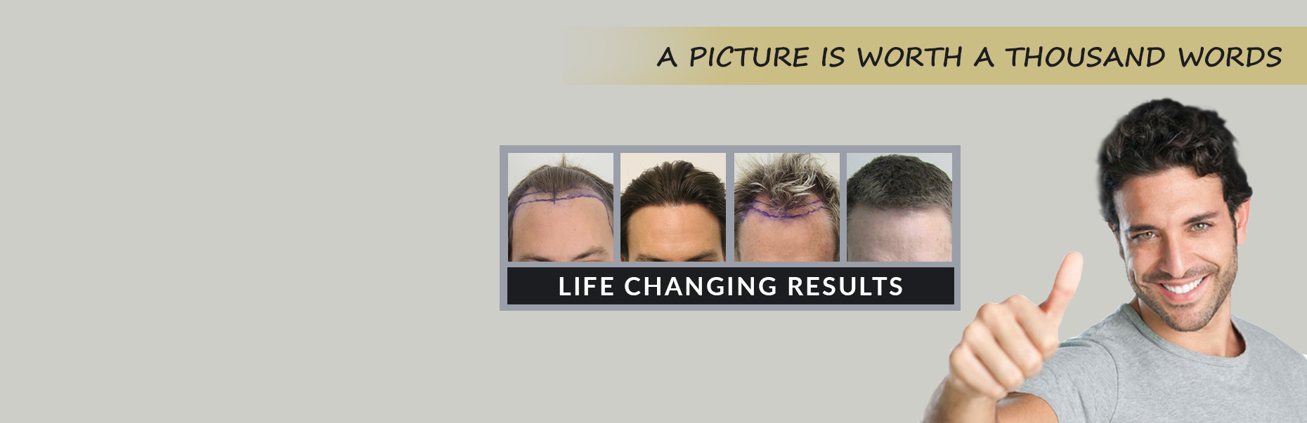 Advantages and Disadvantages of Hair Transplant (Unbiased Review)