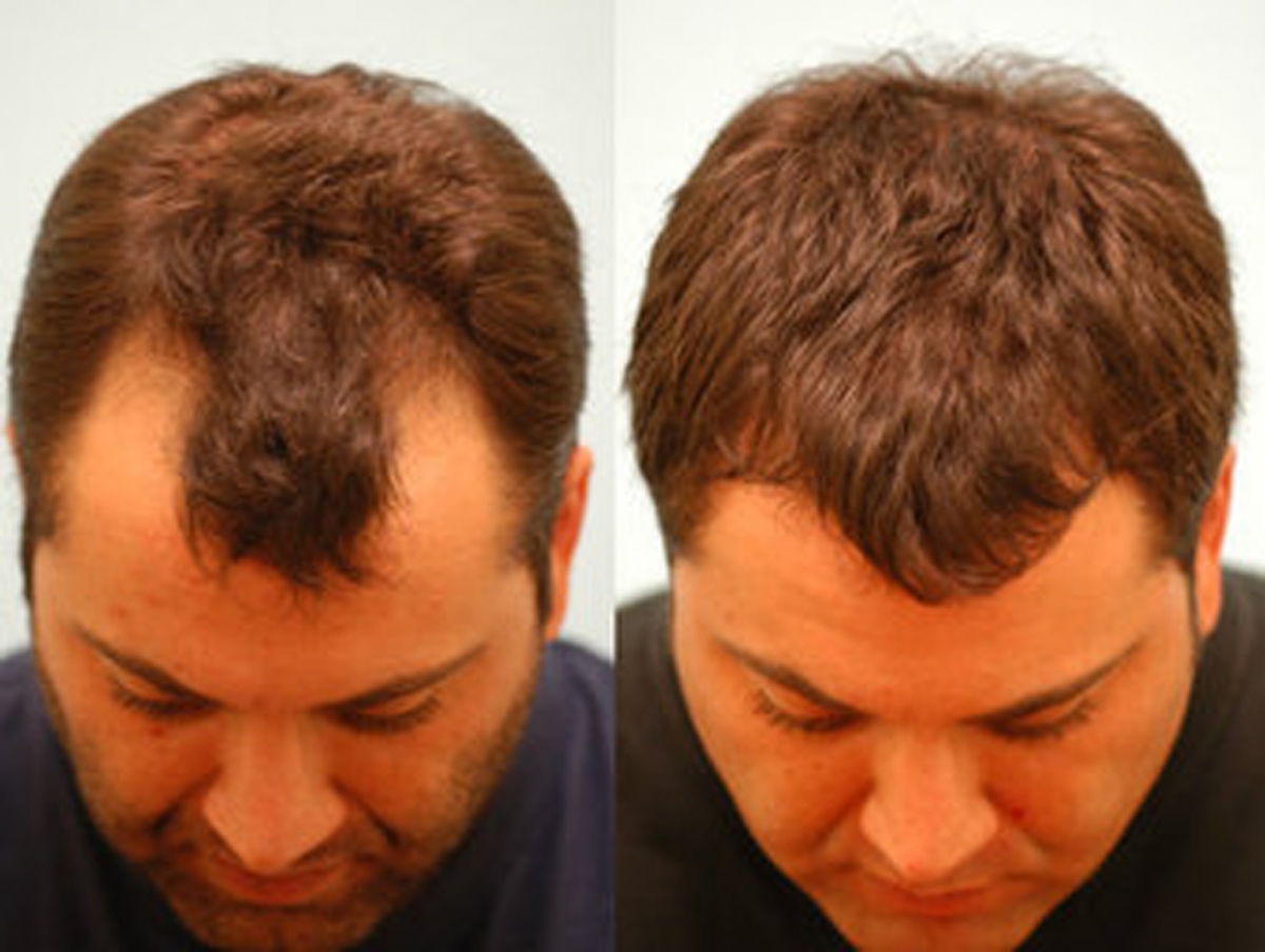 Турецкая пересадка волос. Прически после пересадки волос. Трансплантация волос в Турции. Пересадка волос у мужчин.